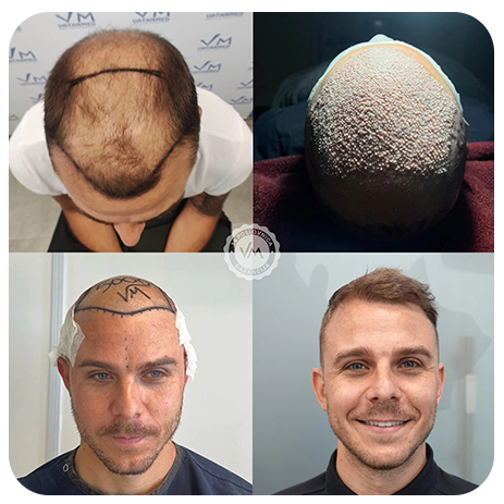 Transplantacija kose
